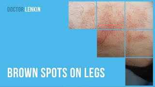 🦵 Brown spots on legs [upl. by Enyak]