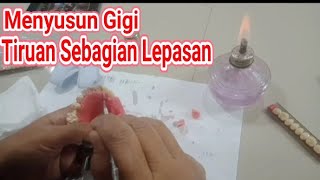 Menyusun Gigi Tiruan Sebagian Lepasan [upl. by Bergstein626]