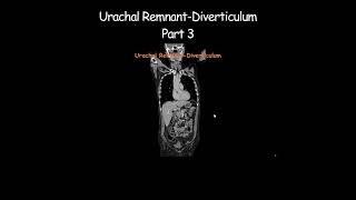 Urachal RemnantDiverticulum Part 3 radiology radiologist embryology urinarybladder [upl. by Leba]