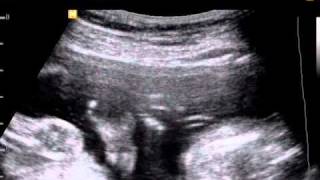 Clinodactyly diagnosed by ultrasound in Down Syndrome [upl. by Ojyma968]