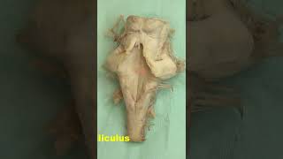 Facial colliculus Rhomboid fossa neuroanatomy brain brainstemrhomboidfossa [upl. by Richella440]