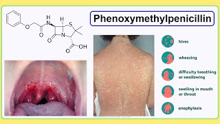 phenoxymethylpenicillin [upl. by Tarttan]