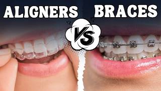 Clear Aligners vs Braces  Invisible Aligners  OrthoSquare Dental Clinic [upl. by Eirdua]