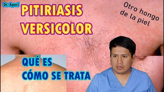 COMO ELIMINAR LA PITIRIASIS VERSICOLOR  OTRO HONGO EN LA PIEL   DR APARI [upl. by Anoynek]