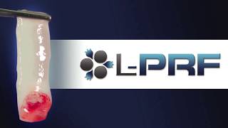 LPRF LeukocytePlatelet Rich Fibrin Bone Grafting for Dental Implants [upl. by Noby960]