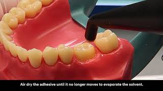 3M™ RelyX™ Ultimate Adhesive Resin Cement Application Video [upl. by Taima]