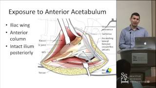 Acetabulum Approaches  Conor Kleweno MD [upl. by Ailenroc]