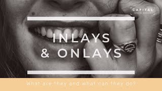 Dental Inlays amp Onlays Explained by Richmond Cosmetic Dentist Dr Graham Forbes [upl. by Aerdnak555]