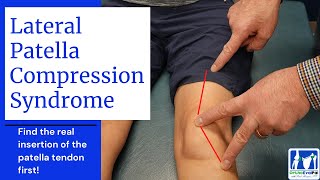 Lateral Patella Compression Syndrome LPCS [upl. by Speroni]