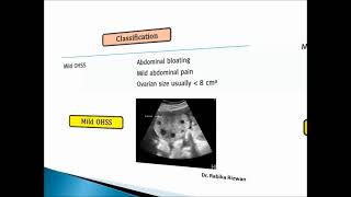 Lecture On OHSS by DrRabika Rizwan  Ovarian hyperstimulation syndrome  exam  mrcog [upl. by Perle]