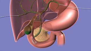 Your Biliary Drain [upl. by Elihu]