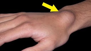 How to Get Rid of Ganglion Cysts Naturally  7 Home Remedies for Ganglion Cyst on Wrist [upl. by Padget]