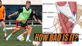 Expert Explains Toni Kroos Injury “Pubalgia” and Return Timeline [upl. by Rolat]