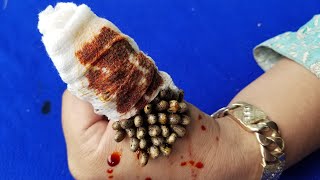 How to remove ticks from hand to be healthy 302 [upl. by Felecia312]