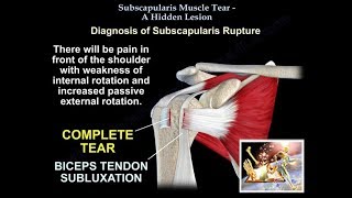 Subscapularis Muscle Tear A Hidden Lesion  Everything You Need To Know  Dr Nabil Ebraheim [upl. by Smoht]