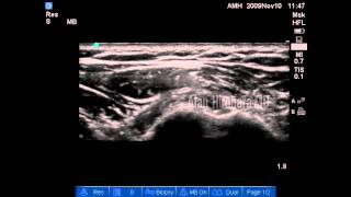 How Biceps Tendon Tears are treated [upl. by Larrisa]