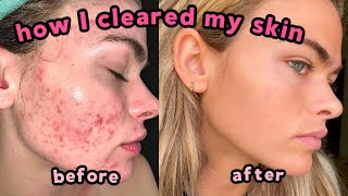 My Accutane Experience amp How I Cleared My Severe Acne  QampA with lots of pictures [upl. by Nifled]