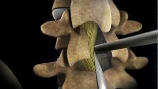 TLIF Transforaminial Lumbar Interbody Fusion  Larry Parker MD [upl. by Eras291]