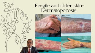 Fragile and thin skin  Dermatoporosis [upl. by Nedyah]