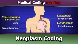 ICD 9 Coding Tutorial — Neoplasm Coding [upl. by Ahsimit]