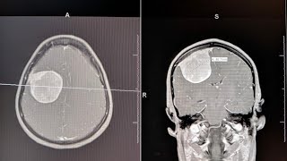 Symptoms of Brain Tumors [upl. by Remy446]