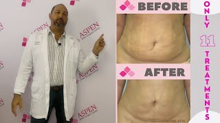 Liposuction Fibrosis Treatment Soften and Smooth Lumps and Bumps [upl. by Adelia]