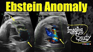 Ebstein Anomaly  Ultrasound  Fetal Echo  Case 345 [upl. by Cis532]