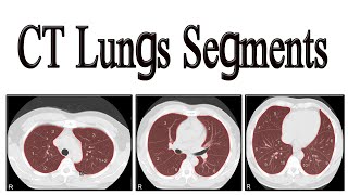 CT lungs segments [upl. by Millhon]