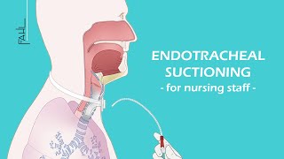 Endotracheal suctioning ETS for nursing staff  Animation  Fahl MedizintechnikVertrieb GmbH [upl. by Alrad264]