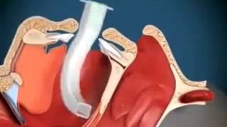 Técnica de Colocação da Cânula Orofaríngea [upl. by Finbur466]