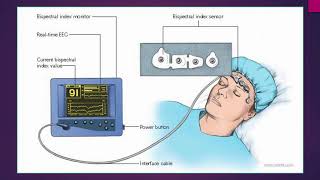 Bispectral index in hypercapnic encephalopathy  Video abstract ID 167020 [upl. by Cirded]