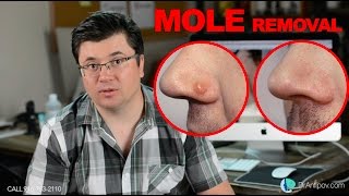 DIY Mole Removal [upl. by Tarsuss]