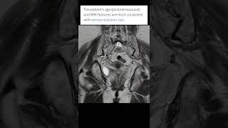 Hemorrhagic Cyst Ovary  Adnexal Cyst  Cyst with internal echoes and Septations  Ovarian Cyst [upl. by Dub]