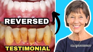 Gum Recession and Bone Loss Reversed Testimonial [upl. by Nairolf]