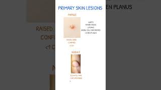 SKIN LESIONS Papule Vs Nodule [upl. by Tizes]