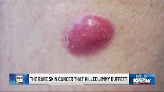 Medical Moment The rare skin cancer that killed Jimmy Buffett [upl. by Tedmund]