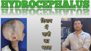 Hydrocephalus A killer disease Hindi  Symptoms amp surgeries  Dr Manish Mishra  Neurosurgeon [upl. by Aeresed]