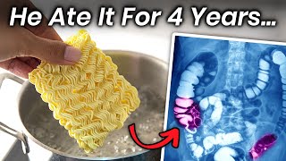 A Boy Ate Instant Noodles for 4 Years This Is What Happened to His Stomach [upl. by Naro412]