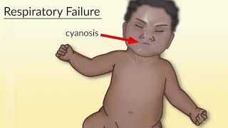 Recognition of Respiratory Failure and Shock in Children by M Kleinman  OPENPediatrics [upl. by Danie]