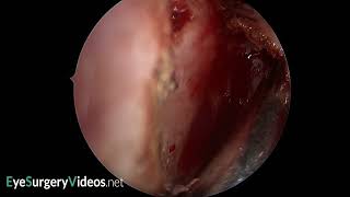 Posteriorly located frontal processlacrimal bone suture line [upl. by Eidnac673]