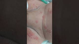 Bullous impetigo vs transient neonatal pustular melanosis [upl. by Harday]