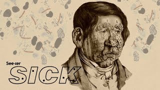 How Does Leprosy Damage the Human Body [upl. by Sucrad]