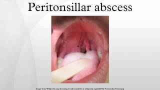 Peritonsillar abscess [upl. by Karlotte]