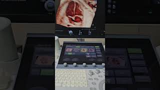 Fetal Echo  4 Chamber View  4D Ultrasound [upl. by Dietrich523]