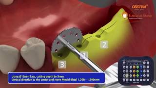 Hiossen  Osstem  ESSET Kit Animation  English [upl. by Aihpledalihp53]