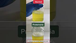 protein leakage in urine treatment in tamil  proteinuria treatment in tamil  சிறுநீரில் புரதம் [upl. by Thun]