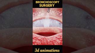 Bronchoscopy Surgery process viral shorts bronchoscopy 3d [upl. by Ydisac]