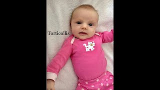 Chapter 2 Torticollis Infant Repositioning for Plagiocephaly [upl. by Leaffar]