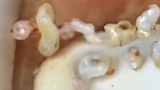 Deep blackhead extraction Cystic acne amp pimple popping 16 [upl. by Netnert]