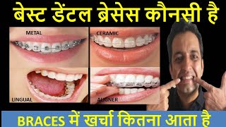 TYPES AND COST OF BRACES HINDIBraces lagane mein kitna kharcha aata hai [upl. by Dadelos]